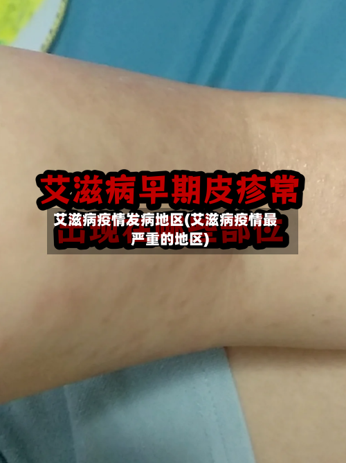 艾滋病疫情发病地区(艾滋病疫情最严重的地区)
