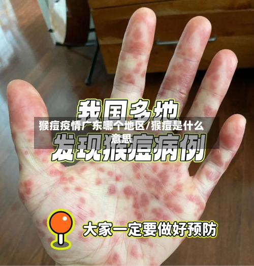 猴痘疫情广东哪个地区/猴痘是什么意思